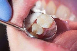 dental filling