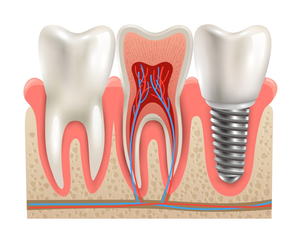 Is a dental implant painful?