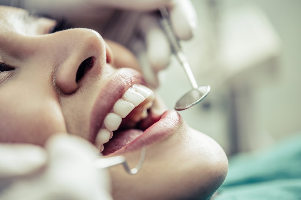 Best Time to Get Dental Veneers