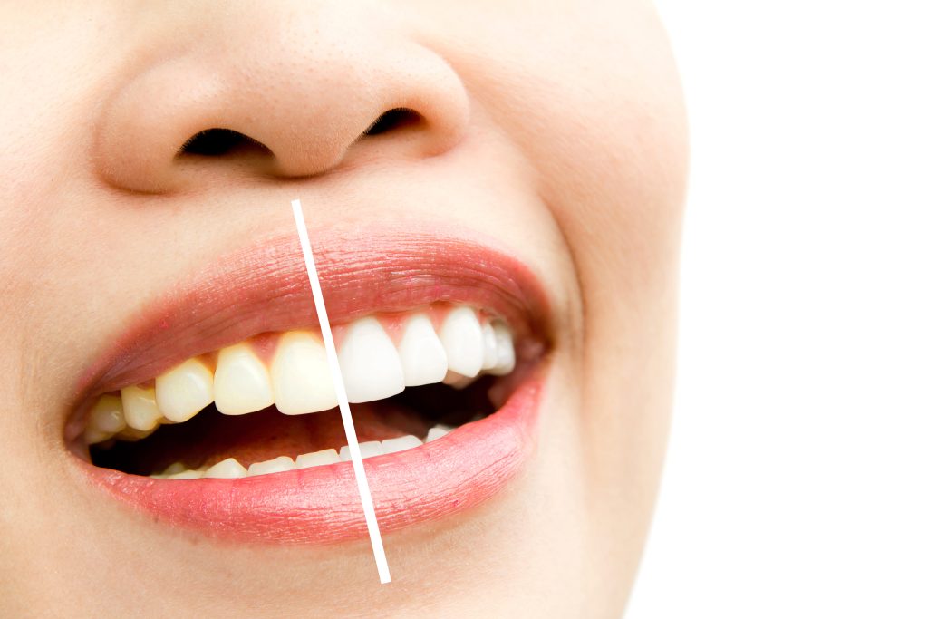 Tips to maintain dental health after veneers